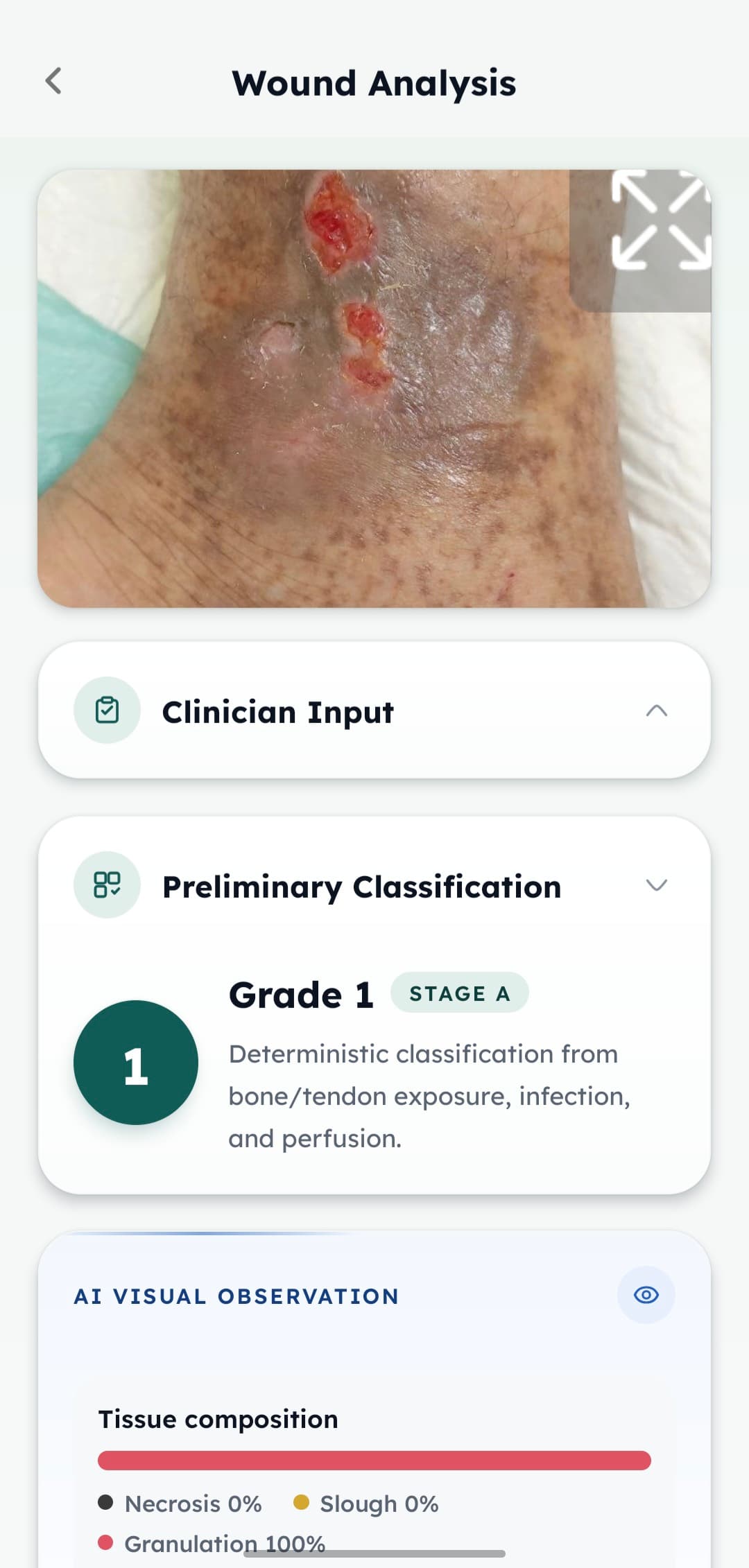Epitello wound analysis screen showing the wound photo, clinician input, and a preliminary classification of Grade 1, Stage A